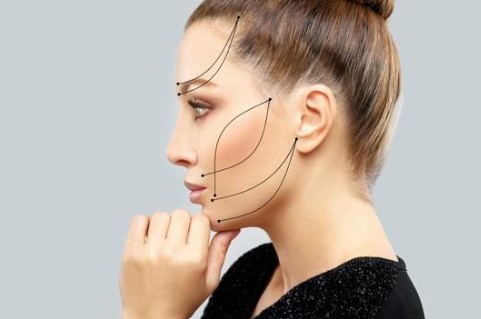 スレッドリフト・イメージ