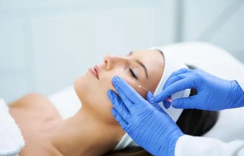 糸リフトイメージ