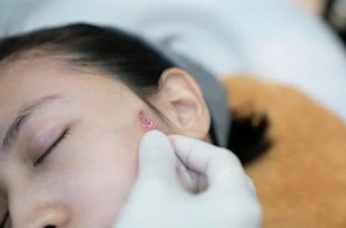 糸リフト施術・イメージ