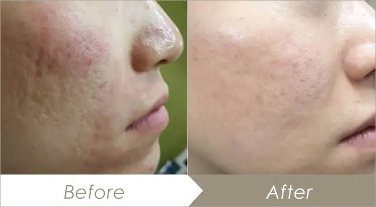 ジュベルック施術前後