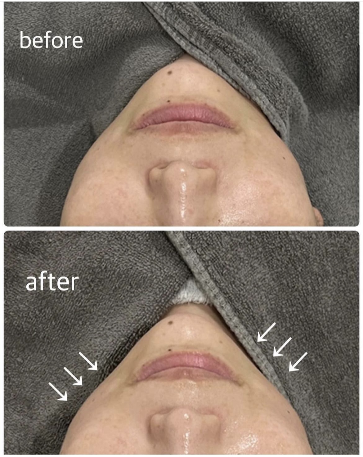 ハイフ前後症例