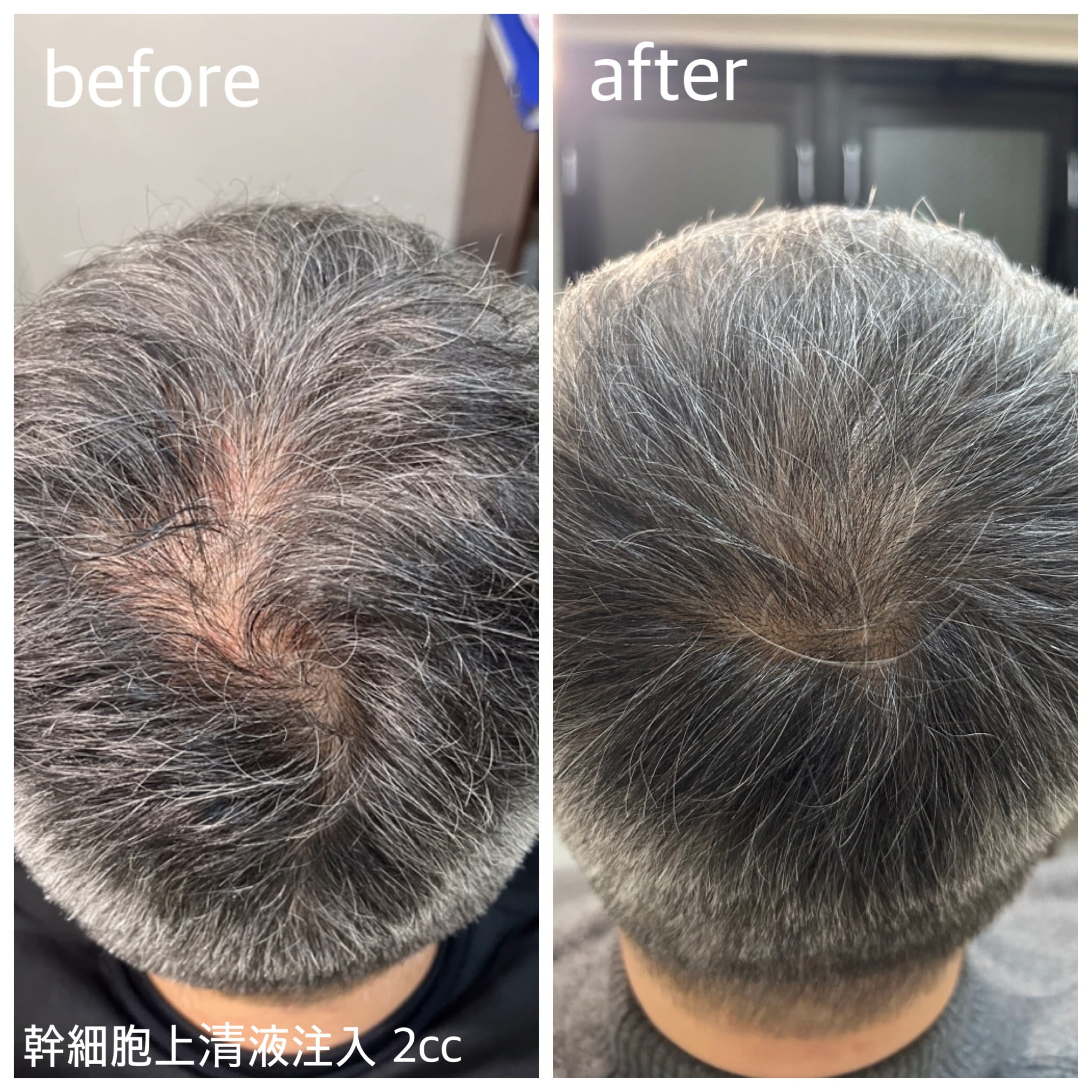 幹細胞培養上清液・リフスキンクリニック