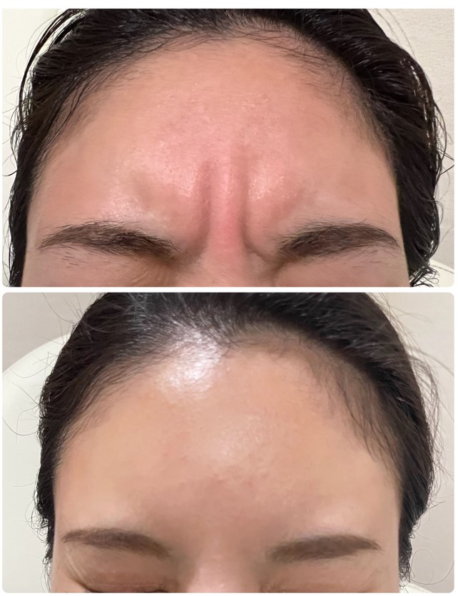 ボトックス症例①