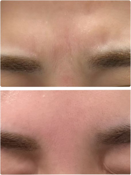 ボトックス症例②